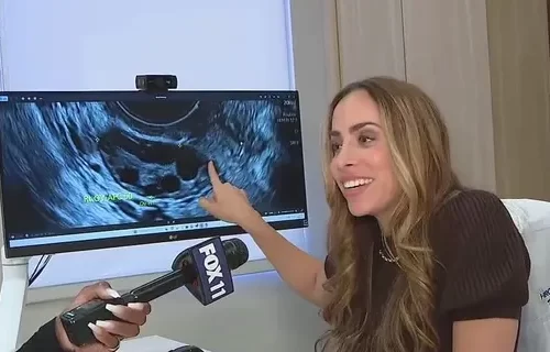 Dr. Sasha Hakman was interviewed by Fox 11 discussing fertility and PCOS.