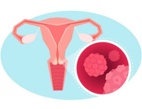 Dr. Lee and Dr. Manuel discuss ovarian cancer.